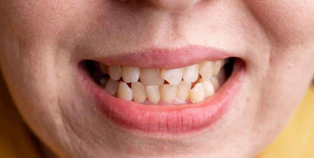Progenia Czym Jest I Jak Leczyć Tę Wadę Zgryzu Polski Dentysta West Bromwich 4244